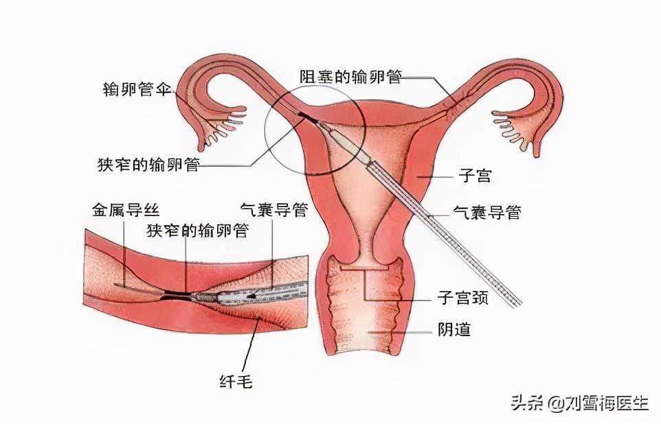 香港验血邮寄血样结果会骗人吗,输卵管堵塞要做试管婴儿吗？主要是看这点！