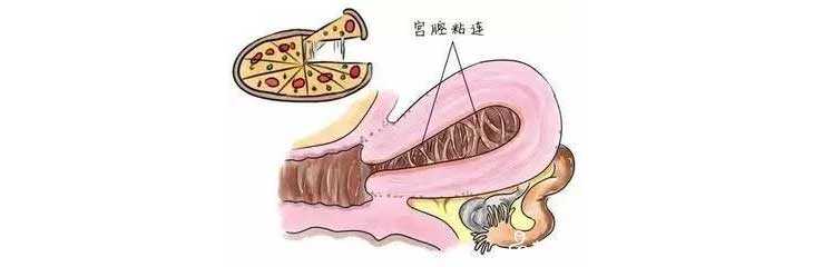 香港验血12个d 报告单,关于轻度、中度、重度宫腔粘连患者做试管的成功率