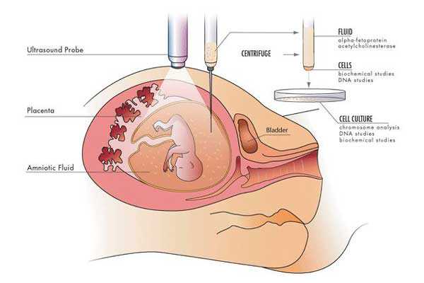 香港验血什么价位,宫腔积液如何影响辅助生殖技术中助孕过程？
